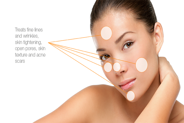 Goochi dermapen Brasov